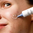 Mossa Acne Act pattanáskezelő fluid (15 ml)